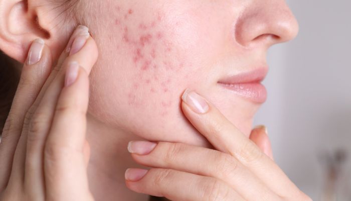 Acne Scar Treatment with Exosome Therapy at The Science of Skin